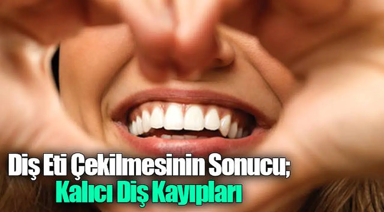 Diş Eti Çekilmesinin Sonucu; Kalıcı Diş Kayıpları