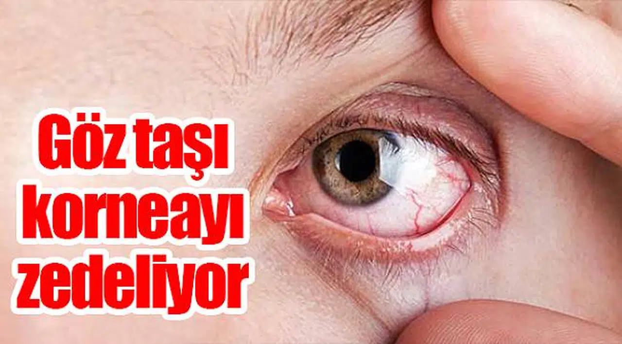 Göz taşı korneaya zedeliyor