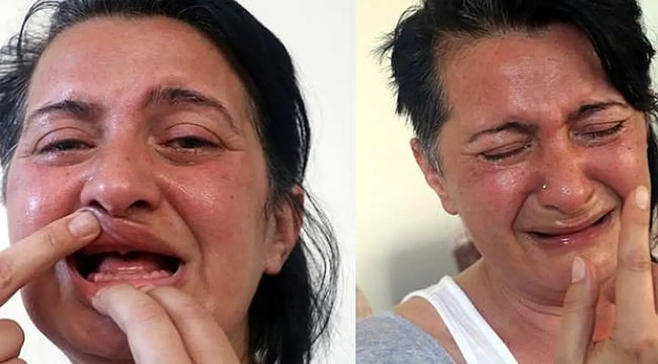 32 dişini kaybeden Sunay Öztürk'ün ağrıları dinmeyince çene sinir uçları kesildi