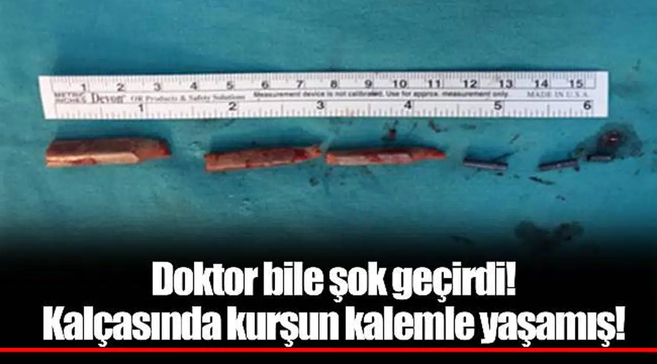 Doktor bile şok geçirdi! Kalçasında kurşun kalemle yaşamış!