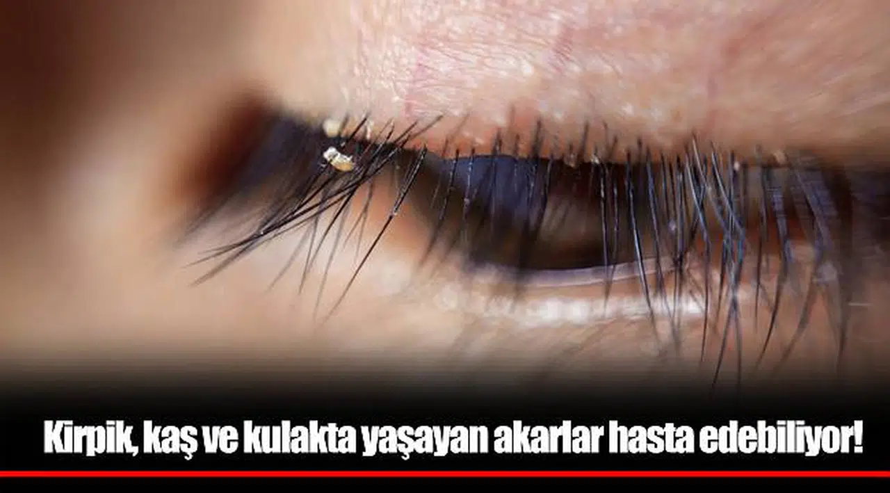 Kirpik, kaş ve kulakta yaşayan akarlar hasta edebiliyor!