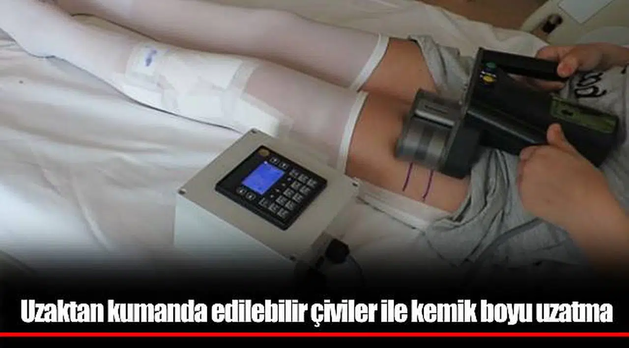 Uzaktan kumanda edilebilir çiviler ile kemik boyu uzatma
