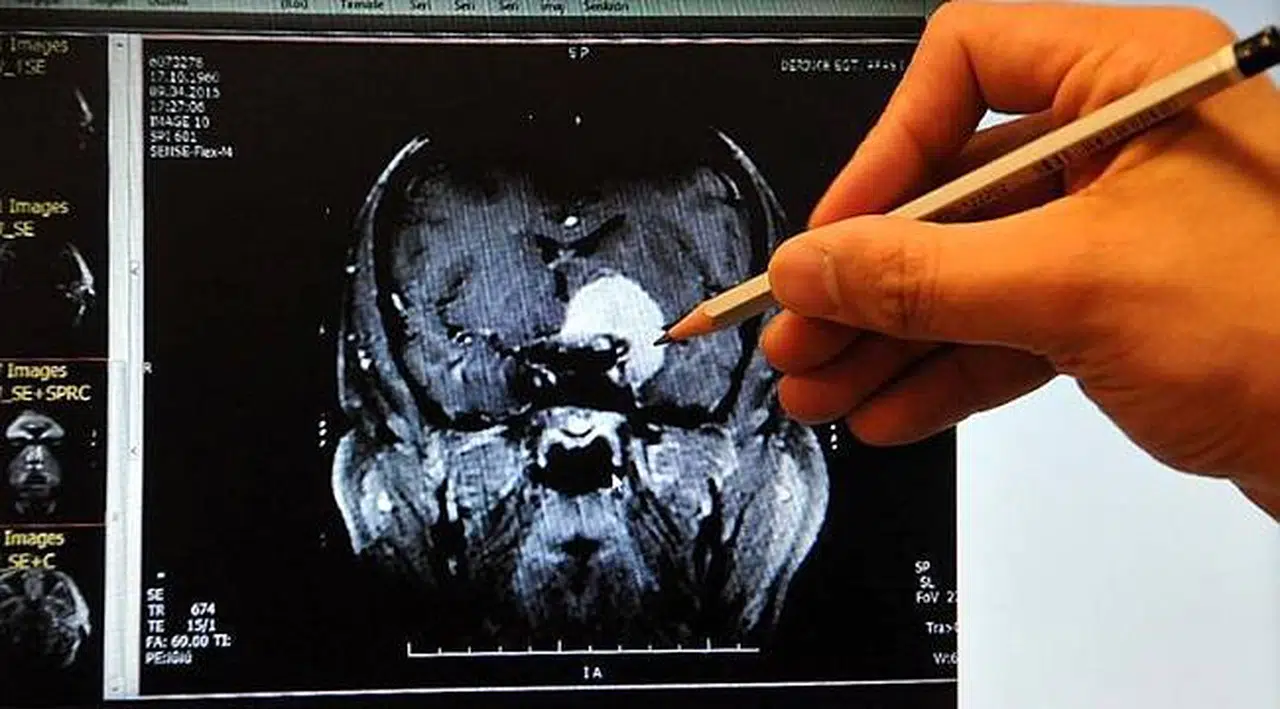 Her 'unutuyorum' diyen kişi Alzheimer hastası mı?
