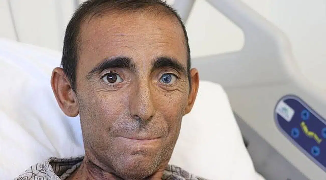 İnanması zor ama gerçek! Beşinci böbreğini karnında taşıyor!