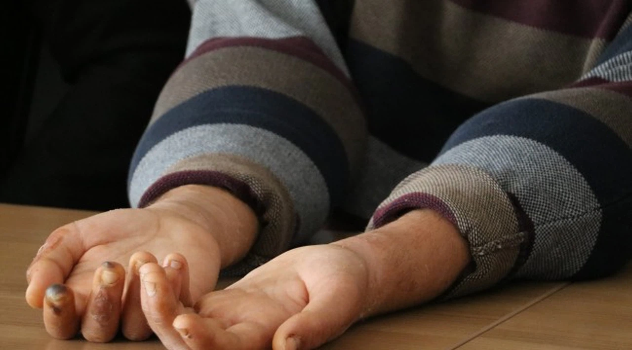 Çift kol nakli yapılan Yusuf: "Elimi kolumu sallayarak gezeceğim"