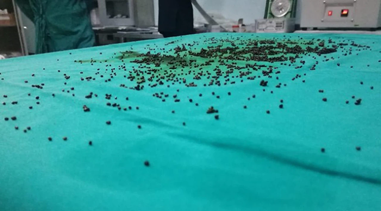 Safra kesesinden 3 bin 765 taş çıkarıldı