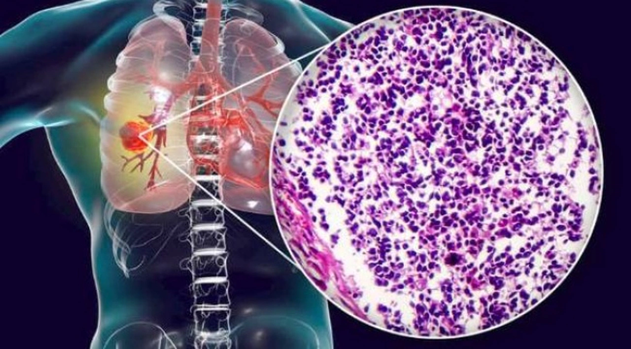 Pandemide geç başvuru nedeniyle ileri evre kanser tanısı arttı