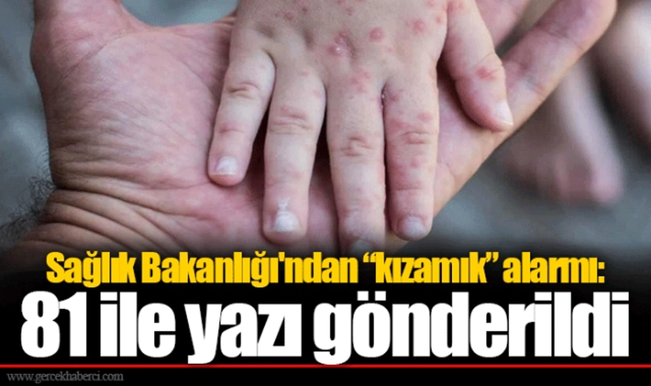 Sağlık Bakanlığı'ndan “kızamık” alarmı: 81 ile yazı gönderildi