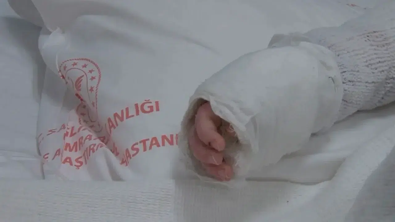 20 aylık bebeğin üzerine kaynar su döküldü! Vücudunun yüzde 27’si yandı
