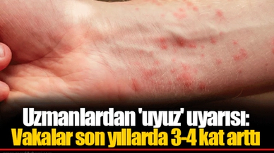 Uzmanlardan 'uyuz' uyarısı: Vakalar son yıllarda 3-4 kat arttı