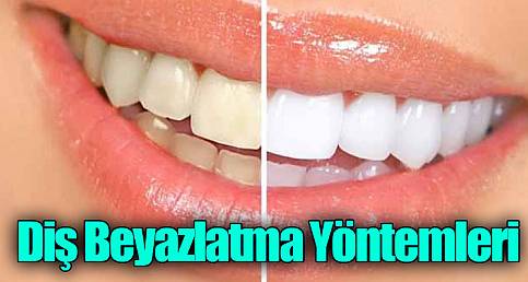 Diş Beyazlatma Yöntemleri