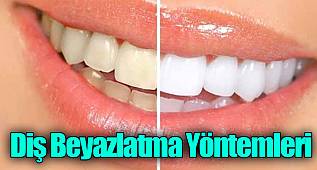 Diş Beyazlatma Yöntemleri