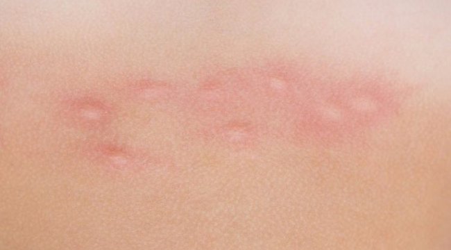 Sinek Isırığı Sanılıyor ama...