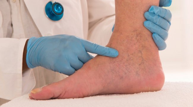 Yaz günlerinin çilesi ödem nedir? Vücuttaki ödem nasıl atılır?