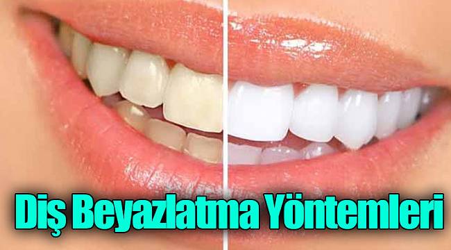 Diş Beyazlatma Yöntemleri