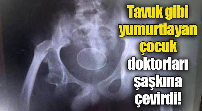 Tavuk gibi yumurtlayan çocuk doktorları şaşkına çevirdi!