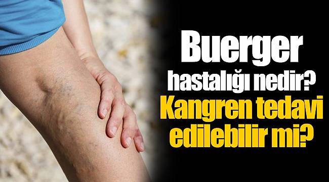 Buerger hastalığı nedir? Kangren tedavi edilebilir mi?