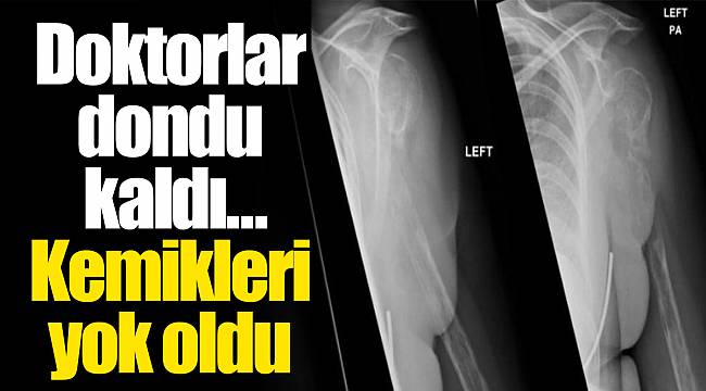 Doktorlar dondu kaldı… Kemikleri yok oldu