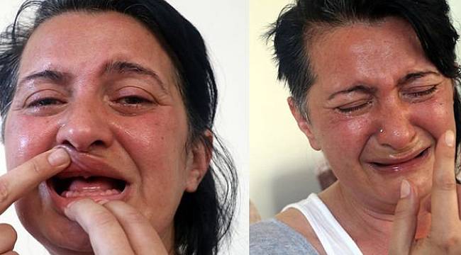 32 dişini kaybeden Sunay Öztürk'ün ağrıları dinmeyince çene sinir uçları kesildi