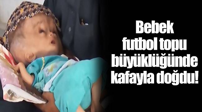 Bebek futbol topu büyüklüğünde kafayla doğdu!