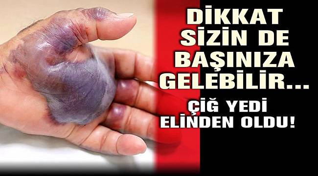 Dikkat sizin de başınıza gelebilir... Çiğ yedi, elinden oldu!