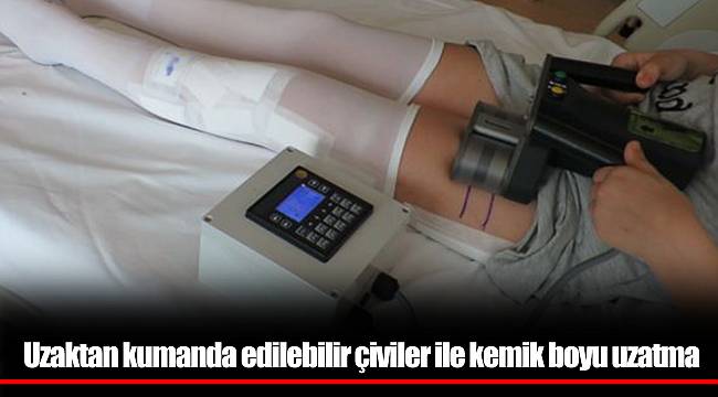 Uzaktan kumanda edilebilir çiviler ile kemik boyu uzatma