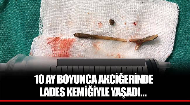 10 AY BOYUNCA AKCİĞERİNDE LADES KEMİĞİYLE YAŞADI…