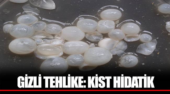 GİZLİ TEHLİKE: KİST HİDATİK
