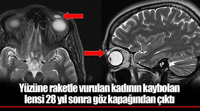Yüzüne raketle vurulan kadının kaybolan lensi 28 yıl sonra göz kapağından çıktı
