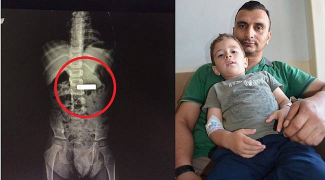 3 yaşındaki Ahmet Eren Yılmaz pil yuttu, röntgeni hayrete düşürdü!