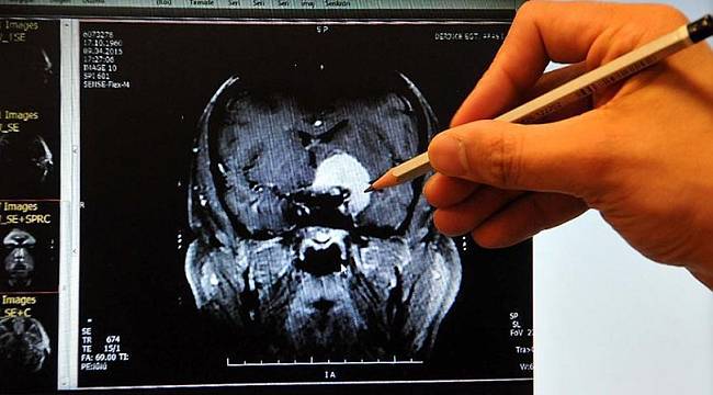 Her 'unutuyorum' diyen kişi Alzheimer hastası mı?