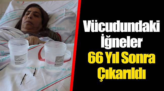 Vücudundaki İğneler 66 Yıl Sonra Çıkarıldı