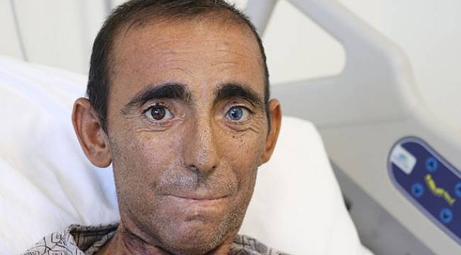 İnanması zor ama gerçek! Beşinci böbreğini karnında taşıyor!