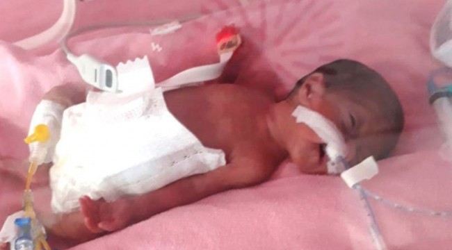 "Parmak bebek" zorlu yaşam mücadelesini kazandı