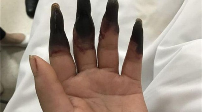Küçük bir kesik 8 parmağının kangren olmasına sebep oldu!