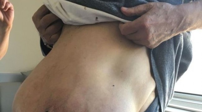 Fransa’da karnı her gün büyüyordu çareyi Türkiye’de buldu