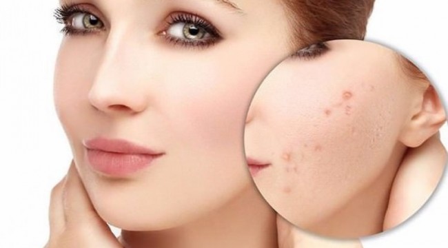 Akne tedavisinde peelingler etkili olabilir