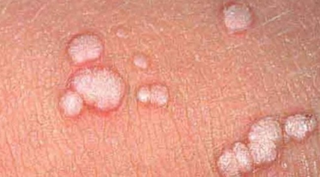 HPV virüsü tüm dünyayı tehdit ediyor