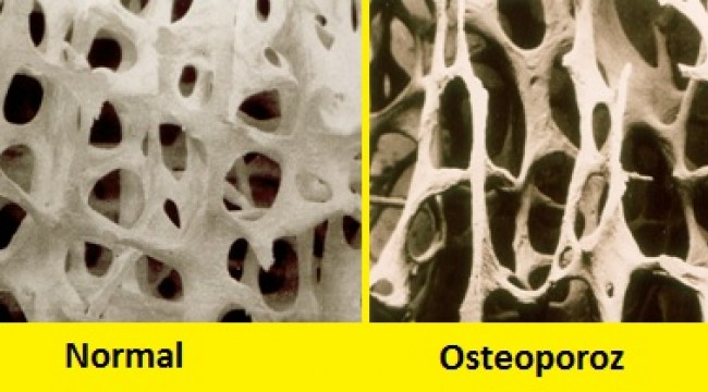 Kemik ağrısı ve boy kısalması osteoporoz belirtisi olabilir