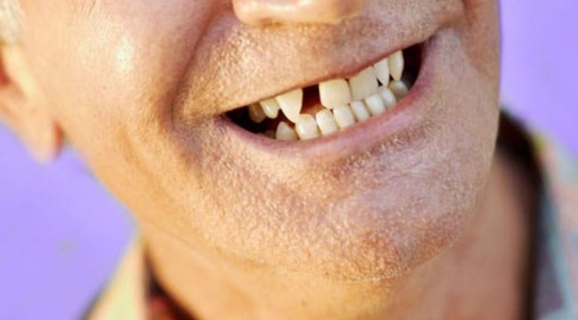 Diş eksikliği sizin de kaderiniz olmasın