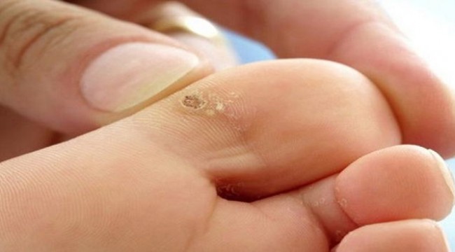 Geçmeyen siğillere D vitamini enjeksiyon tedavisi yüz güldürüyor