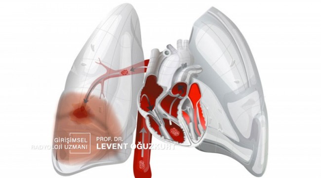 Sesiz ölüm Pulmoner emboli