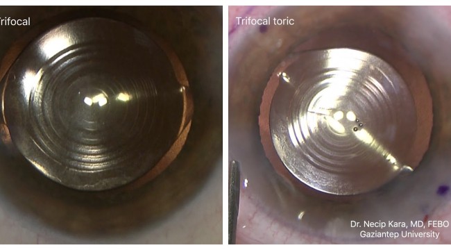 Trifokal lensle dünyası netleşti