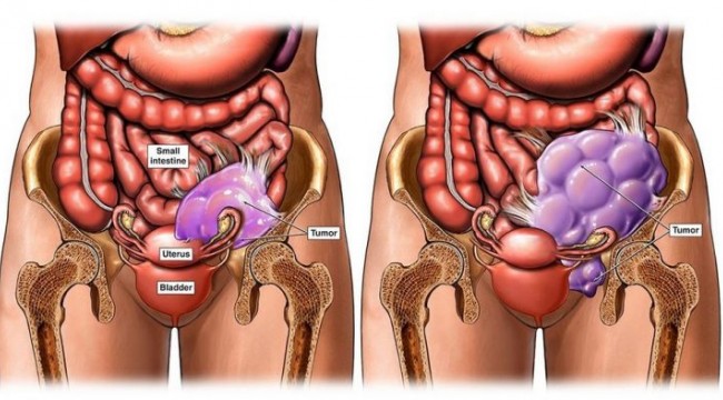Yumurtalık kanseri gençlerde bile görünüyor
