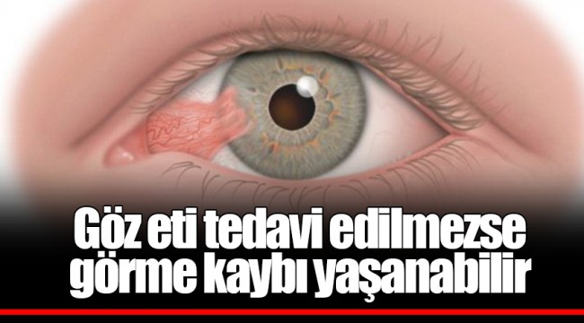 Göz eti tedavi edilmezse görme kaybı yaşanabilir