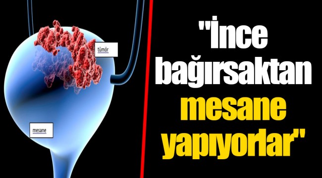 "İnce bağırsaktan mesane yapıyorlar"