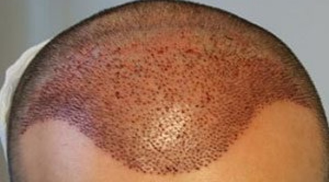 Saç ekiminde ön saç çizgisi en önemli kurallardan biri