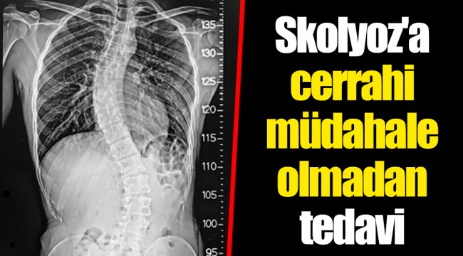 Skolyoz'a cerrahi müdahale olmadan tedavi