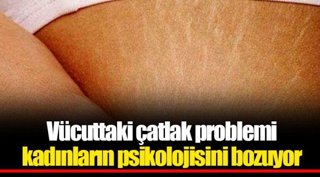 Vücuttaki çatlak problemi kadınların psikolojisini bozuyor