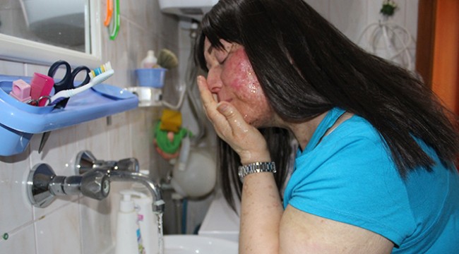 Yıllara sonra suyla barıştı, güneşle barışamadı